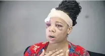  ?? MIAMI HERALD ?? LaToya Ratlieff talks about her experience on June 2, 2020, after a Fort Lauderdale police officer shot her in the face with a rubber bullet.