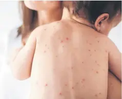  ??  ?? The number of new measles cases in the first two months of this year already surpasses the entire annual totals of all but three years since the disease was declared eliminated in 2000.