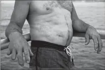  ?? SCOTT MCINTYRE / THE NEW YORK TIMES ?? James Church shows maimed fingers from a lightning strike he suffered earlier this year while fishing at Lighthouse Point Park in Ponce Inlet, Fla. Church was fishing and thought he was safe because he could not hear thunder from the storm on the horizon.