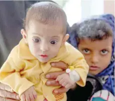  ?? — AFP ?? A Yemeni child suffering from malnutriti­on is seen at a treatment centre in a hospital in the country’s third-city of Taiz on Wednesday.