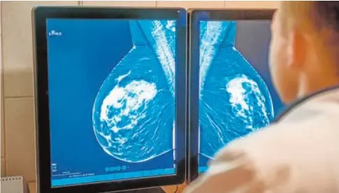 ?? // ABC ?? Un radiólogo examina una mamografía en busca de lesiones cancerosas