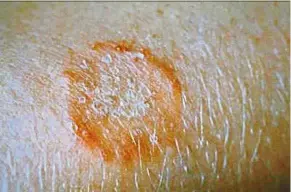  ??  ?? Ringworm is one type of fungal infection that our body can usually fight off, but such infections can be deadly in those with compromise­d immune systems.