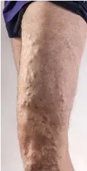 ??  ?? BEFORE: Ian’s painful leg