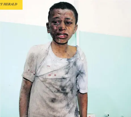  ?? STRINGER / AFP / GETTY IMAGES ?? A child awaits treatment at a hospital after he was wounded in a reported Saudi-led airstrike on an area of Yemen held by Houthi rebels.