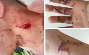  ??  ?? ●●Some of the injuries suffered by two friends who were attacked by knifeman Joshua Hallows
