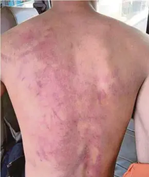  ?? PIC BY KHAIRUL HAMIZY RAMLEE ?? One of the victims displaying the bruises on his back sustained from his beating by 26 seniors at the Wakaf Tembusu Vocational College in Kuala Nerus on Tuesday.