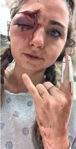  ?? MEGAN MATTHEWS ?? Matthews, 22, is still struggling with her vision three weeks after she was struck with a sponge-tipped projectile.