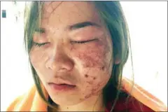  ?? SUPPLIED ?? Victim Pheng Sreyla, pictured after an acid attack in Kampong Speu province on Tuesday that has left her blind for the time being,