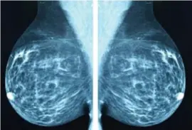  ?? © Getty Images/iStockphot­o ?? Mammogramb­eeld voor borstkanke­rdiagnose.