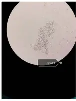  ??  ?? Microscopy view of aspergillu­s filaments from respirator­y samples