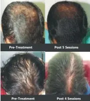  ?? PHOTO: HTCS Sessions ?? Pre-Treatment
Pre-Treatment
Post 5
Sessions
Post 4