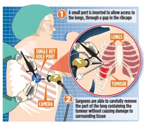  ??  ?? LESS INVASIVE: The new procedure is not as risky and cuts time in hospital