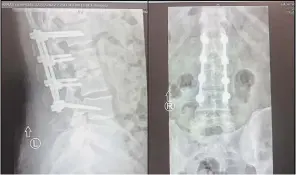  ?? DARCY PATRICK ?? X-rays show the pins and rods Darcy Patrick had to have placed along his spine after a bacterial infection started to eat through the bone.