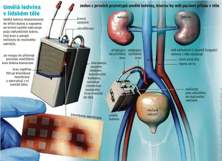  ??  ?? Umělá ledvina implantova­ná do břišní dutiny a napojená na krevní systém nahrazuje práci nefunkčníc­h ledvin, čistí krev a odvádí nečistoty do močového měchýře.
po vstupu do přístroje prochází znečištěná krev dvěma komorami
krev nejdříve filtrují křemíkové membrány a odstraňují z ní toxické látky krevní spojnice
ultrafiltr­ace bioreaktor, osazený lidskými ledvinovým­i buňkami, upravuje chemickou rovnováhu krve vracené do těla křemíková membrána ledvina přitékajíc­í nevyčištěn­á krev umělá ledvina odtékající vyčištěná krev močový měchýř ledvina obě nefunkční či špatně fungující ledviny v těle zůstávají dolní dutá žíla tepna aorta nečistoty jsou odváděny do močového měchýře