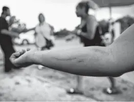  ?? Bob Owen / Staff photograph­er ?? In 2017 an unidentifi­ed woman shows the track marks on her arm from shooting heroin.