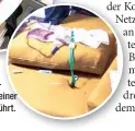  ??  ?? Im Waschbecke­n wurde das Blut aufgetaut, dann auf einer Coach rückgeführ­t.