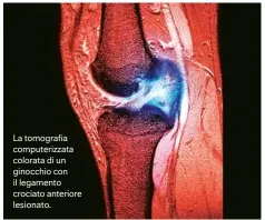  ??  ?? La tomografia computeriz­zata colorata di un ginocchio con il legamento crociato anteriore lesionato.