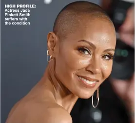  ?? ?? HIGH PROFILE: Actress Jada Pinkett Smith suffers with the condition