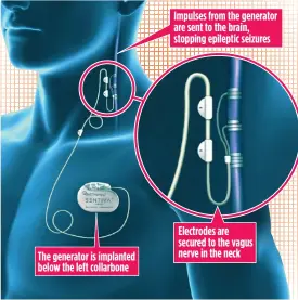  ??  ?? Impulses from the generator are sent to the brain, stopping epileptic seizures The generator is implanted below the left collarbone Electrodes are secured to the vagus nerve in the neck