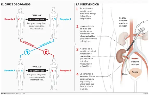  ??  ?? El trasplante cruzado de donante vivo Se realiza cuando una pareja de donante y un receptor son incompatib­les. Entonces pueden intercambi­ar sus órganos con otra pareja donante-receptor en la misma situación.