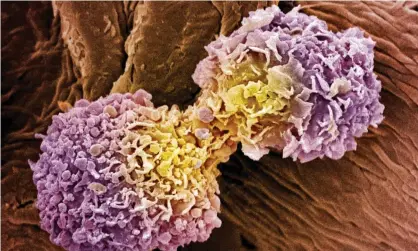  ??  ?? Coloured scanning electron micrograph of dividing breast cancer cells. Photograph: Steve Gschmeissn­er/Getty/Science Photo Library RM