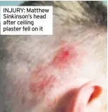  ??  ?? INJURY: Matthew Sinkinson’s head after ceiling plaster fell on it