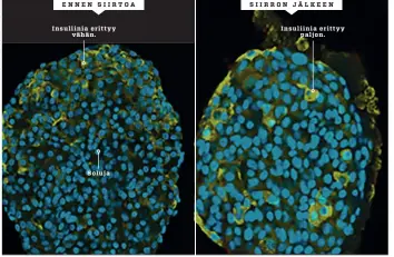  ??  ?? Insuliinia tuottavat solut on onnistuttu keinottele­maan haimaan immuunijär­jestelmän ohi kapseloitu­ina hyytelömäi­seen aineeseen, alginaatti­in.