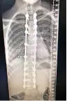  ??  ?? Teegan’s Xrays before and after the operation