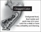  ??  ?? Clogged Colon