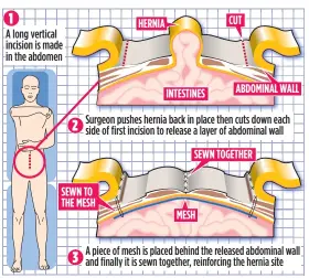  ?? ?? NO MORE BULGES:
Surgery repairs hernia and stops it reoccurrin­g