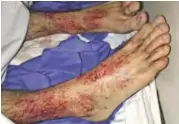  ??  ?? MELBOURNE: In this picture at Sandringha­m Hospital in Melbourne, teenager Sam Kanizay’s feet are seen covered in what looked like hundreds of bleeding little pin holes.— AP