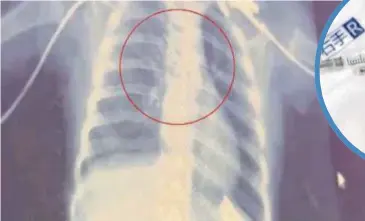  ??  ?? GAMBAR X-ray menunjukka­n kedudukan jarum di dalam tekak kanak-kanak berkenaan. - Agensi