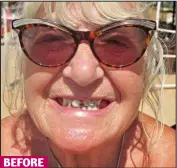  ??  ?? BEFORE
Spot the difference: Bette Allen is delighted with her new teeth, which cost £4,000