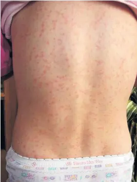  ?? Creative Commons ?? > The fine, red, itchy rash caused by scarlet fever