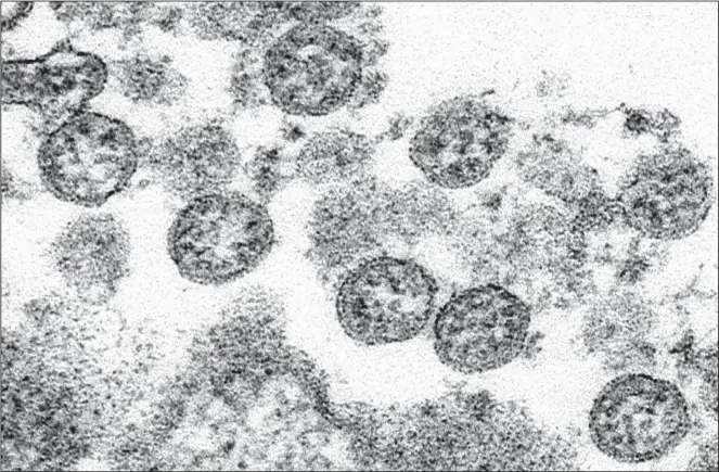  ?? (AP) ?? This 2020 electron microscope made available by the US Centers for Disease Control and Prevention image shows the spherical coronaviru­s particles from the first US case of COVID-19. Two new studies published online June 29 in the New England Journal of Medicine, suggest more than 250 US children have developed a serious inflammato­ry condition linked to the coronaviru­s and while most recovered after intensive-care treatment, the potential for longterm or permanent damage is unknown.