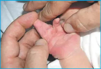  ??  ?? La sindactili­a es una condición inusual en la que dedos de manos, pies, o ambos, están unidos debido a factores genéticos