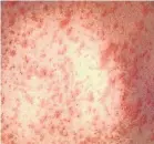  ?? PROVIDED BY THE CENTERS FOR DISEASE CONTROL AND PREVENTION ?? A closeup of the skin of a patient with a measles rash. Six cases of measles have been confirmed in Broward County, Fla.