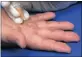  ??  ?? PAIN: A sugar solution injected into the hand could help relieve carpal tunnel syndrome