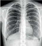  ??  ?? This lung X-ray shows permanent scarring caused by prolonged exposure to silica particles like those released during the cutting of engineered stone.