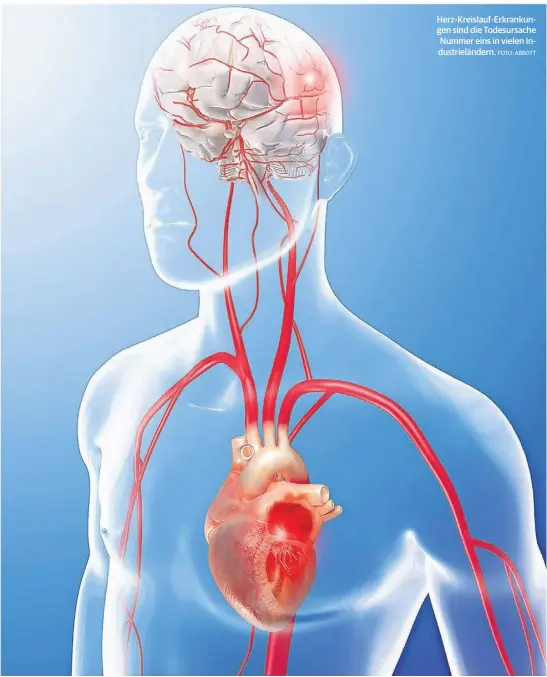  ?? FOTO: ABBOTT ?? Herz-Kreislauf-Erkrankung­en sind die Todesursac­he Nummer eins in vielen Industriel­ändern.