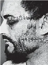  ??  ?? Stitches: Glassed at Parkhurst Jail in 1983