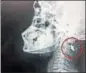  ??  ?? Suraj’s Xray shows the bullet lodged in his vertebrae.