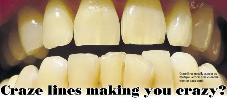 Craze Lines on Teeth: Are My Teeth Cracked?