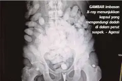  ??  ?? GAMBAR imbasan X-ray menunjukka­n
kapsul yang mengandung­i dadah
di dalam perut suspek. - Agensi