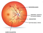  ?? ?? Diabetic retinopath­y.