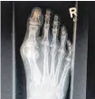  ??  ?? So sieht ein Hallux valgus, eine Ballenzehe, auf einer Röntgenauf­nahme aus.