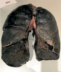  ?? PHOTOS: ROB STOCK/STUFF ?? From the Body Worlds exhibition: Rugby action as you’ve never seen it before, and a smoker’s blackened lungs.