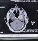  ??  ?? An MRI image shows the tumour located behind Dean Baker’s right eye.