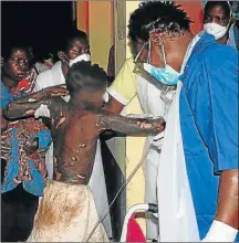  ?? Picture: AFP ?? SCARRED: A badly burned child arrives at the provincial hospital in Tete on Thursday after a truck carrying petrol burst into flames