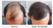  ??  ?? A ‘before and after’ photo of a client sporting a fuller head of hair ten months after a hair transplant.